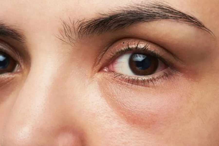 Nuốt ruồi trên mí mắt có ý nghĩa gì? Có tốt hay không?